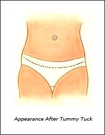 abdominoplasty