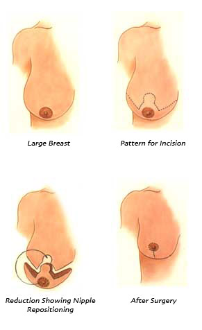 Reduction Procedure