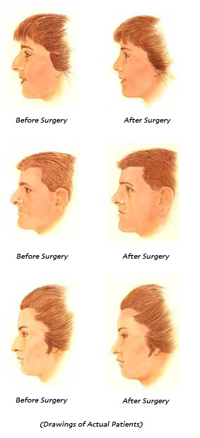 Before and After Rhinoplasty